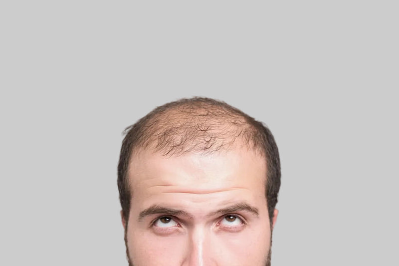 Chute de cheveux homme : ce que la science valide  vraiment, du minoxidil à la greffe.